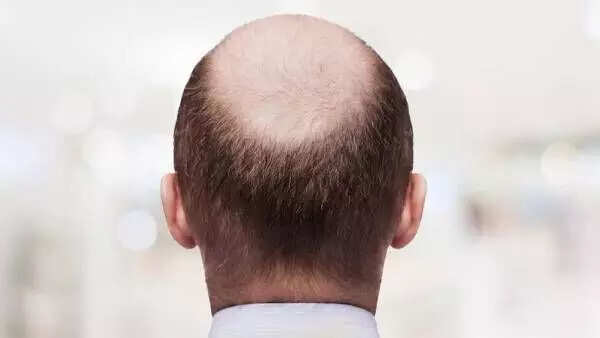 வழுக்கை தலையால் வேலை இழந்த நபருக்கு ரூ.70 லட்சம் இழப்பீடு!!