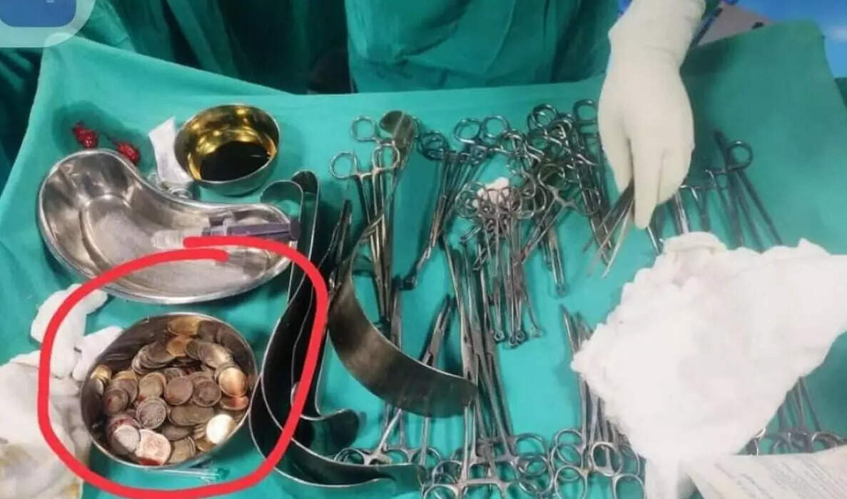 முதியவரின் வயிற்றில் இருந்த 187 நாணயங்கள்!!