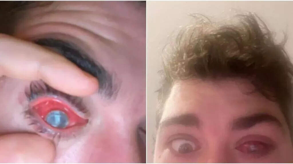 உஷார்! இளைஞருக்கு திடீரென காணாமல் போன கருவிழி!!