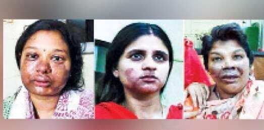 5 மாத கர்ப்பிணி மகள் மீது ஆசிட் வீச்சு. துடிக்க துடிக்க தந்தை செய்த கொடூரம்..!