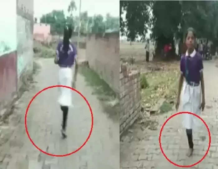 ஒற்றைக்காலுடன் தினமும் 2 கி.மீ. தூரம் பள்ளி செல்லும் சிறுமி!!