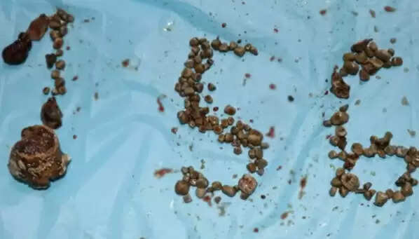 ஒரே நபர் கிட்னியில் 156 கற்கள்.. இந்திய மருத்துவர்கள் சாதனை !