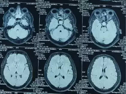 ரஜினிகாந்த் மூளையில் இருந்த கட்டி மூக்கு வழியே அகற்றம்.. திருச்சி டாக்டர்கள் சாதனை..!
