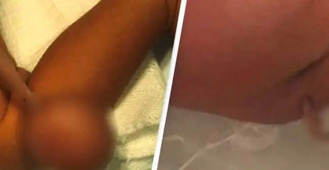 நிஜ வால் பையன்.. பிரேசிலில் 12 சென்டி மீட்டர் நீள வாலுடன் பிறந்த குழந்தை..!!