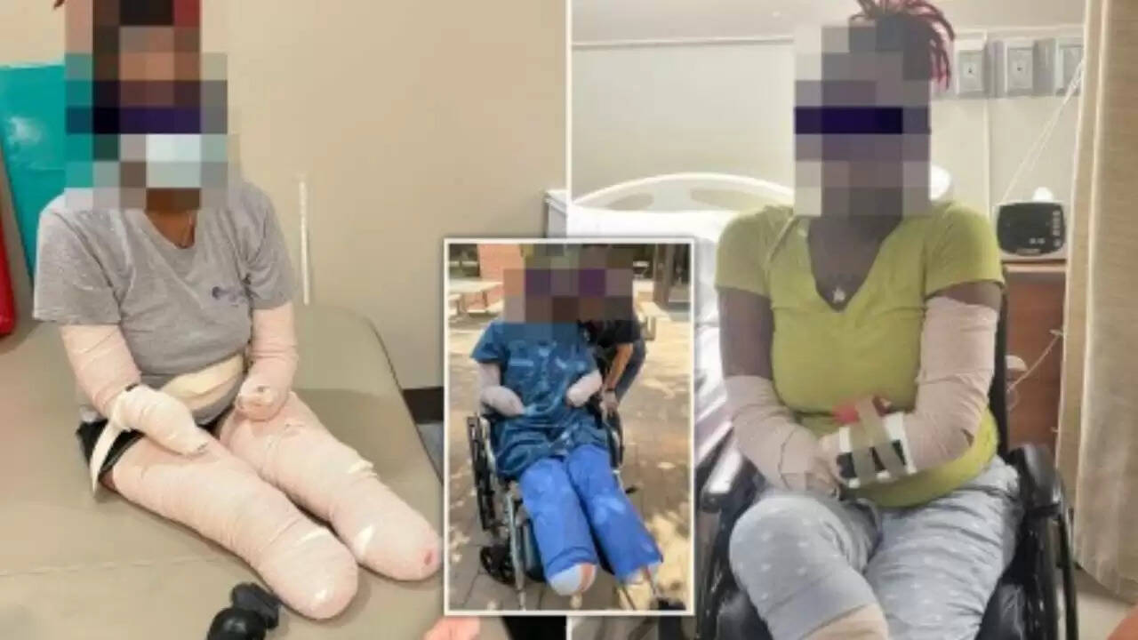 கொரோனாவால் கை, கால்களை இழந்த இளம் பெண்! கண்ணீர் விட்டு அழுத மருத்துவர்: வெளியிட்ட வீடியோ..!!