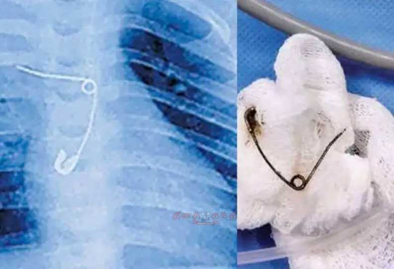 அலட்சியத்தின் உச்சம்...!! 8 மாத பச்சிளம் குழந்தையின் சுவாசக் குழாயில் ஊக்கு..!