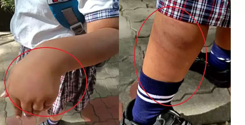 பிரச்சினை தொடங்கியது.. 4ஆம் வகுப்பு மாணவிக்கு சரமாரி அடி.. ஆசிரியை மீது போலீசில் புகார்