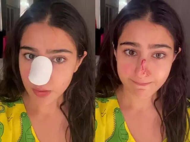 படப்பிடிப்பின் போது உடைந்த மூக்கு.. பெற்றோரிடம் மன்னிப்பு கேட்ட பிரபல நடிகை !!