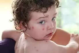 உயிருக்கு ஆபத்தான நிலை இல்லை.. தக்காளி காய்ச்சல் குறித்து அமைச்சர் தகவல்..!