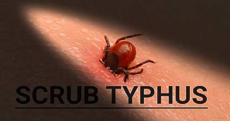 வடமாநிலங்களை மிரட்டும் புது வைரஸ்.. ஸ்க்ரப் டைபஸ் அறிகுறிகள் என்ன?