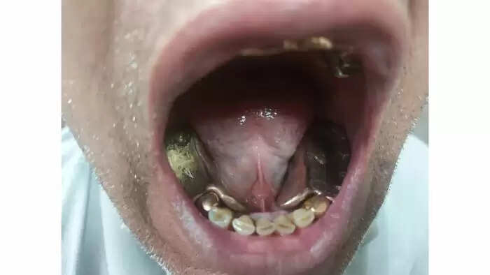 வாயில் ஒரு கிலோ தங்கத்தை கடத்தி வந்த 2 பேர் கைது..!!