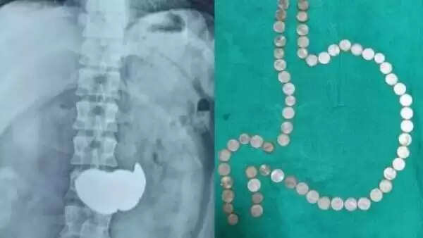 இளைஞரின் வயிற்றை ஸ்கேன் செய்த போது காத்திருந்த அதிர்ச்சி..!! மிரண்டுபோன மருத்துவர்கள்..!!