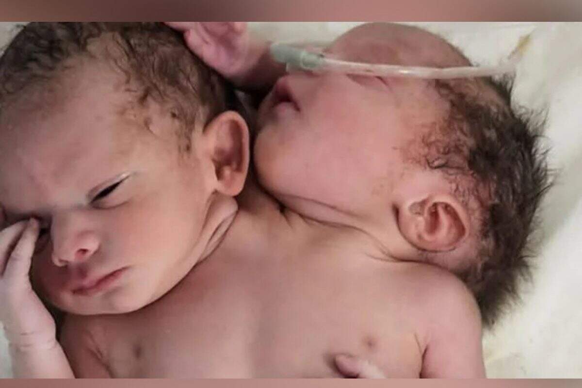 2 தலைகள், 3 கைகளுடன் ஒட்டிப்பிறந்த அதிசயக் குழந்தை.. ஆனால்.. !!