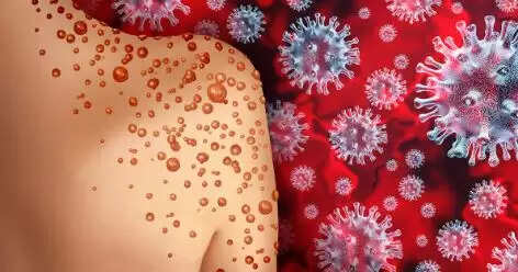 கேரளாவில் மேலும் ஒருவருக்கு குரங்கு அம்மை உறுதி..!!